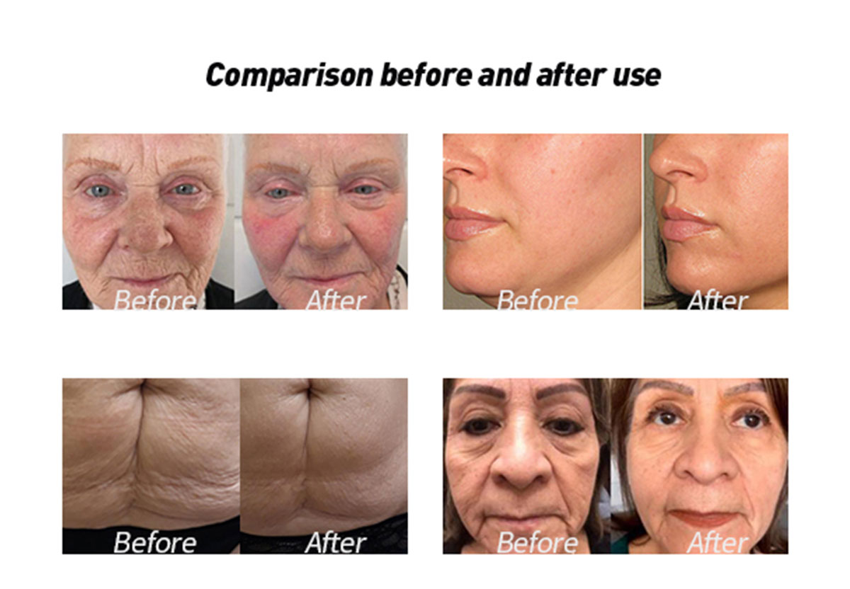 Professional hifu facial hifu face lift machine 7D 9D 11D hifu machine